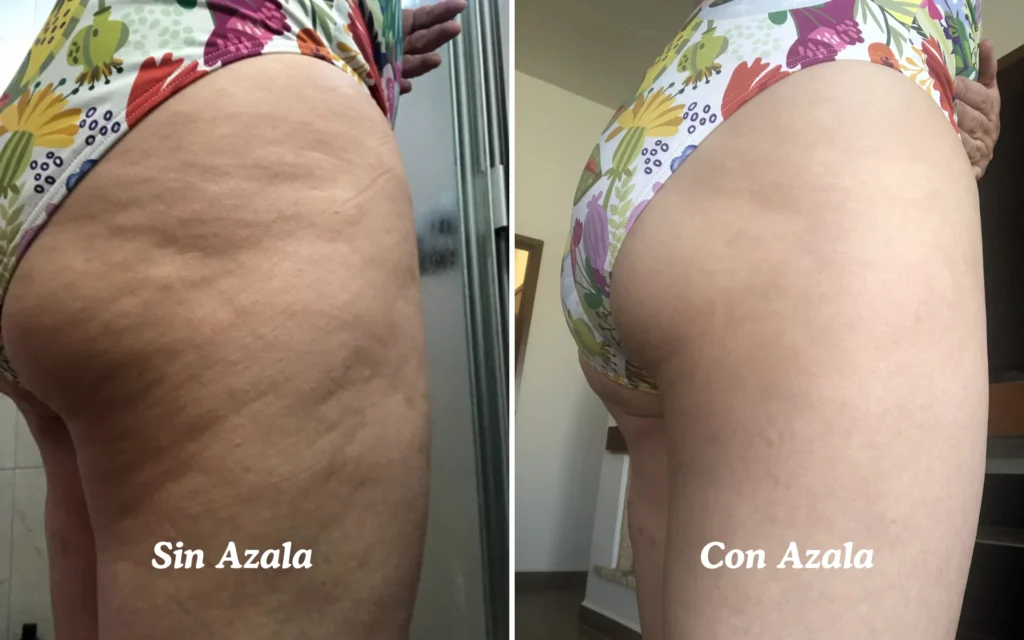 Antes y después de tratar la celulitis blanda con productos Azala Natura.