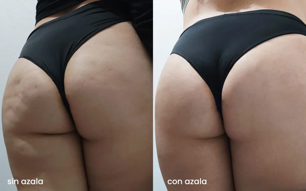 Antes y después del tratamiento Azala Natura para reducir la celulitis.