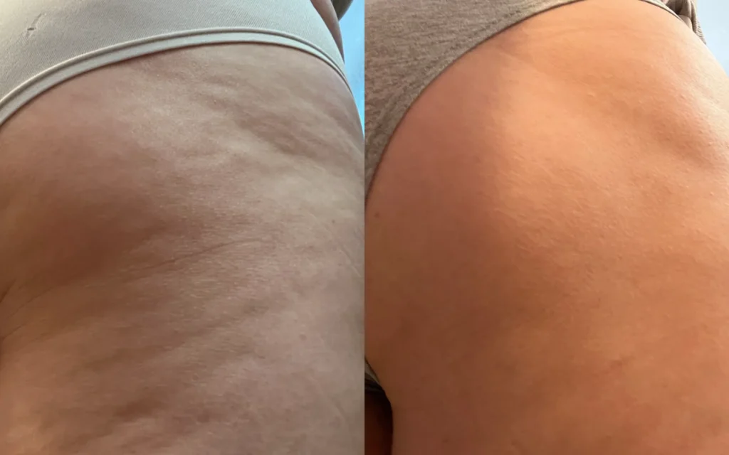 Eliminar celulitis: métodos y recomendaciones para mejorar la piel